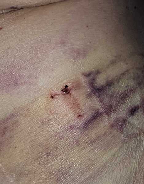 Bruising after surgery