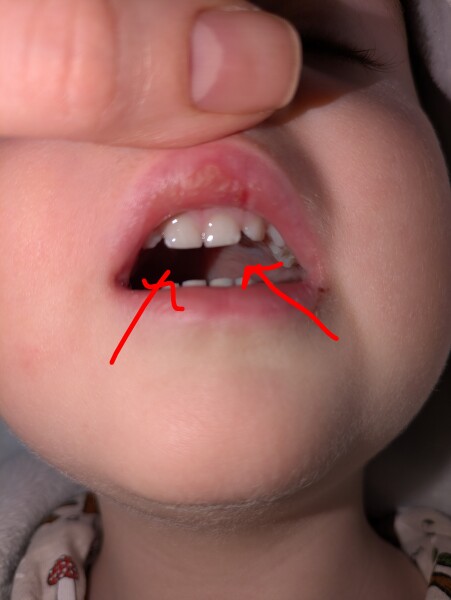 Toddler tooth decay?