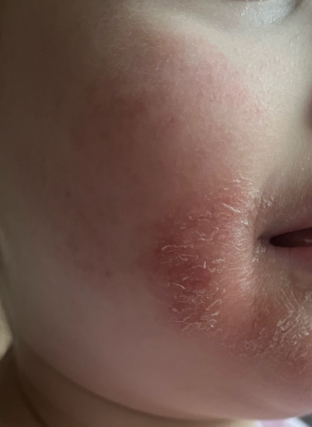 Is this eczema or perioral dermatitis (or something else) on a child’s face?