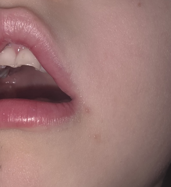 Do these spots look like pimples or possible cold sores?