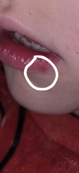 Does this look like the start of a cold sore on my son's lip?