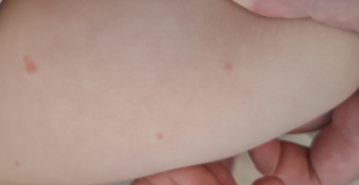Is this the start of chicken pox or something else? (Pics attached)