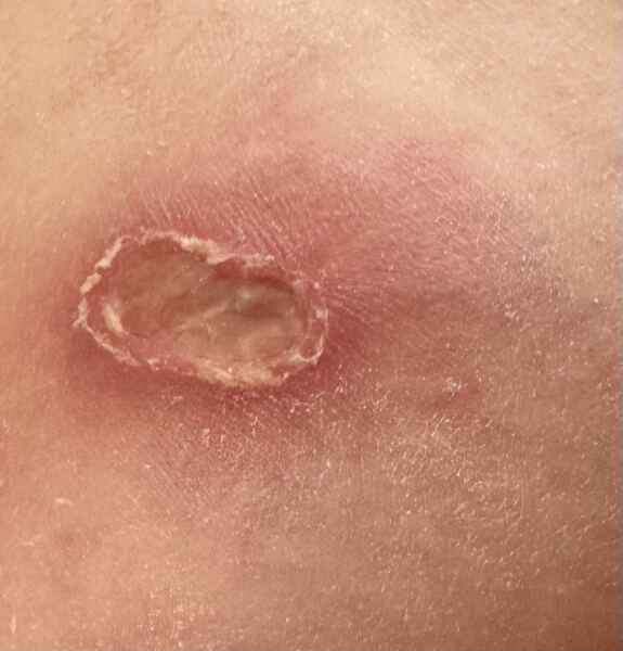 Is this a spider bite? Worried about Mum. Graphic photo.