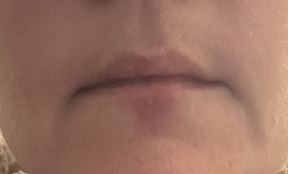 Does anyone know what this is under my bottom lip? (Pic included)