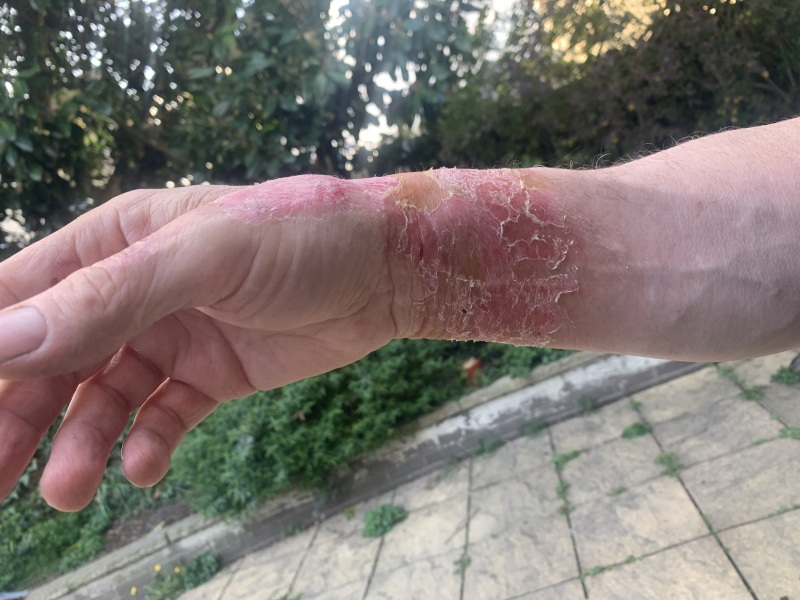 Any medical professionals? Advice on DH severe scald please