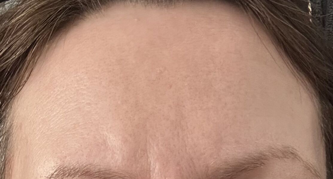Do you think Botox or filler would be better for me? (