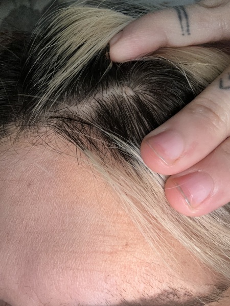 Small hard scalp lump for years, now worried after Googling