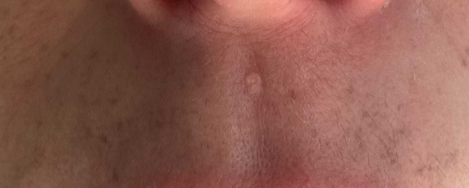 Removal of small skin tags on face