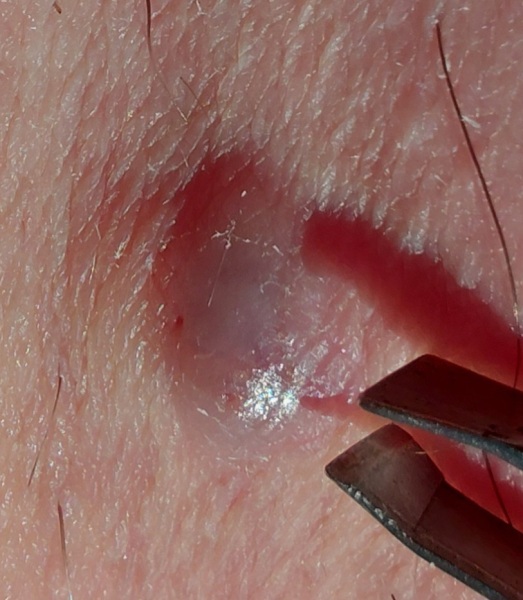 How would you deal with this ingrown hair?