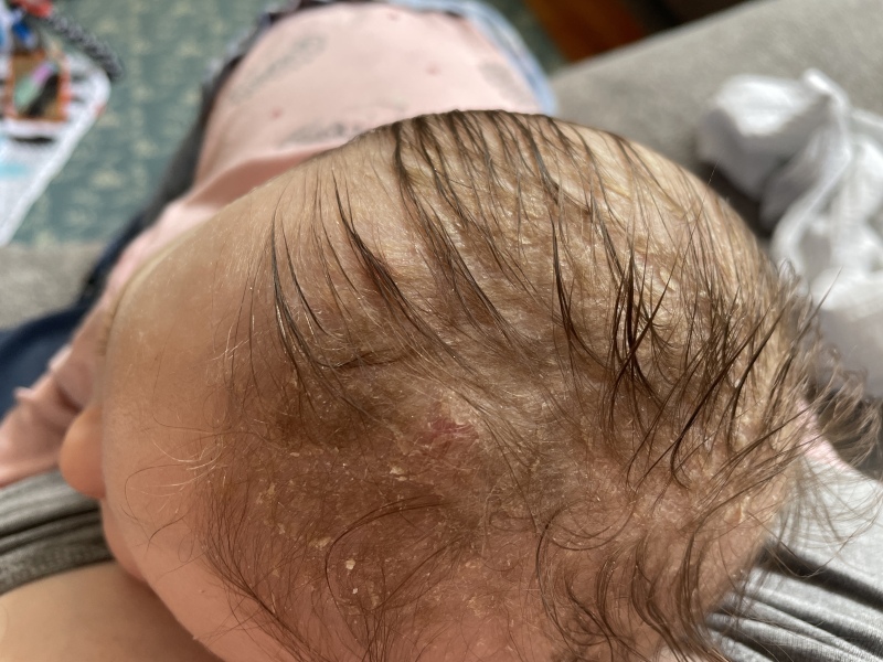 Raised lump on baby’s head