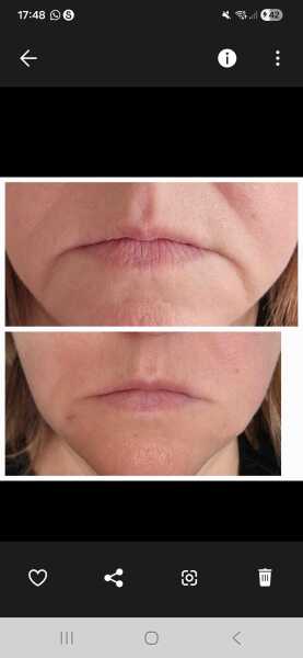 Droopy mouth