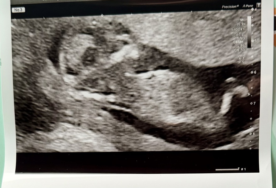 Can anyone see the nub from this dating scan image?