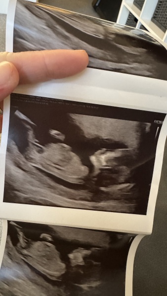 Did anyone have a boy nub on their 12 week scan but end up having a girl?