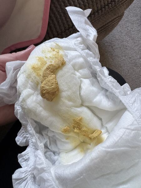 Pale baby poo