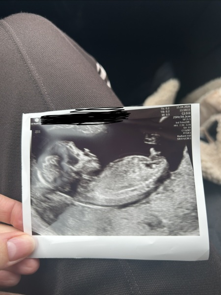 Nub theory after dating scan