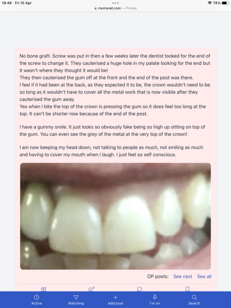 Dental implants - your experiences