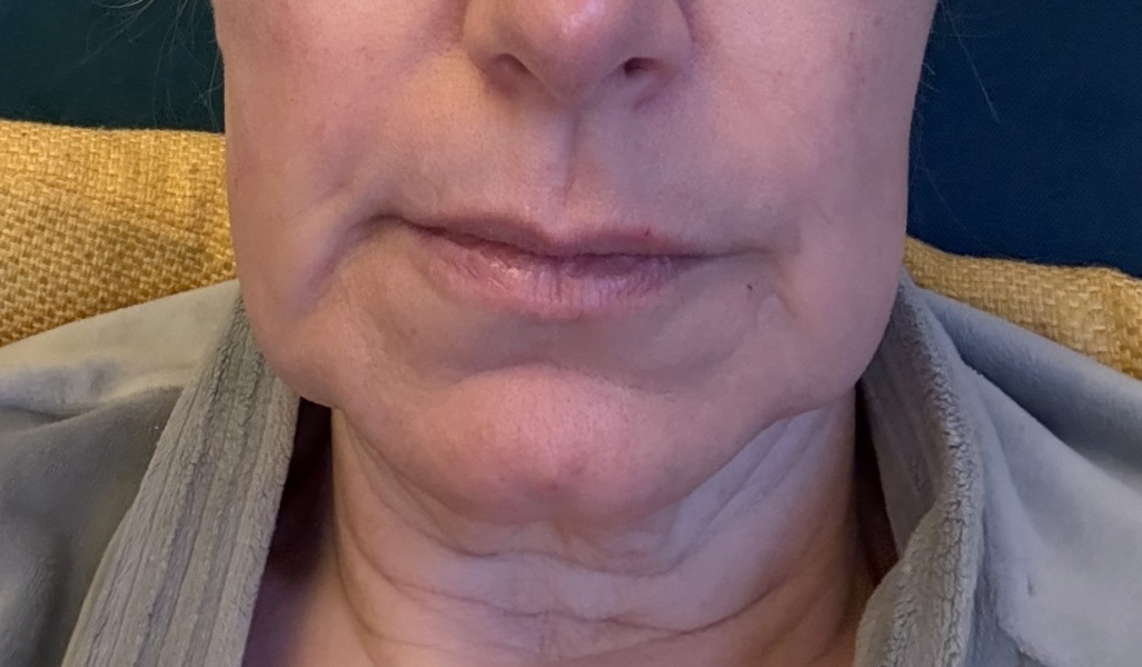 Please talk to me about filler/botox