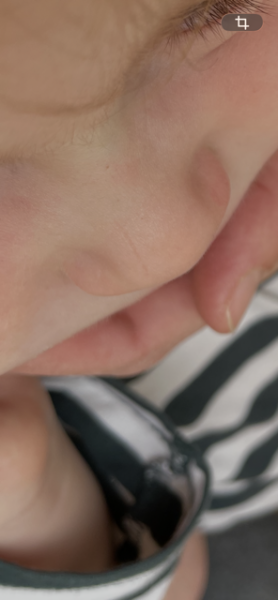 Child scar - experiences please?