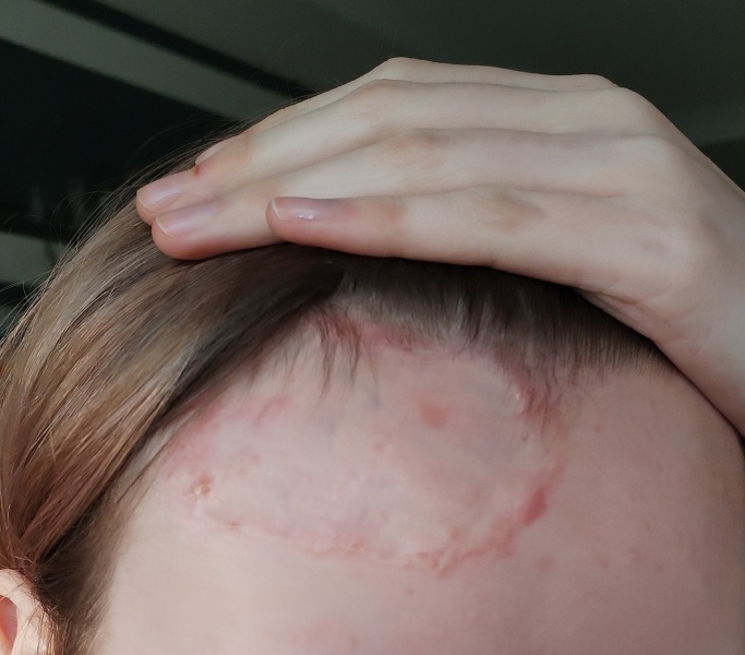 Daughter in hospital - full thickness burns