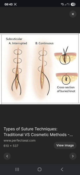 Bruising after surgery