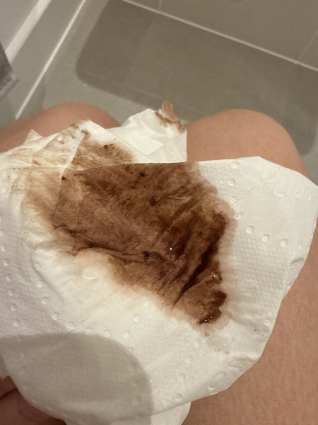 Brown spotting, measuring behind at early scan and worried about outcome