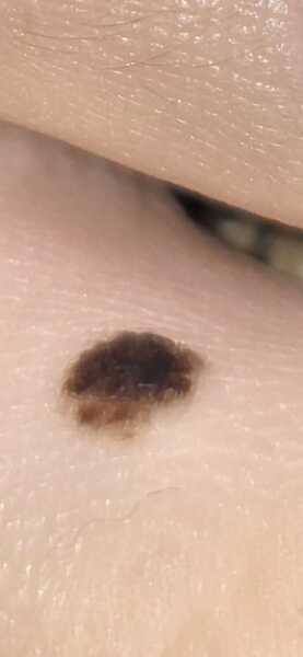 Possible skin cancer in 12 yr old