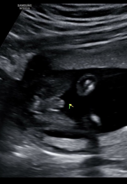Confusing Gender Reveal Ultrasound 16weeks