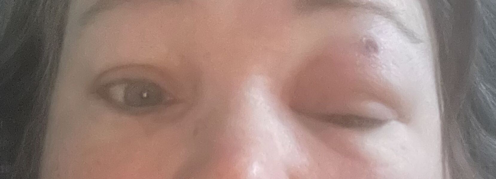 Infected insect bite