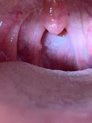 Slim coloured growth back of throat