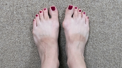 How the hell to cope with bunions?!