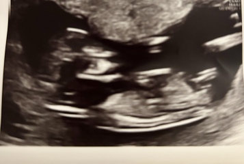 Any guesses on baby's sex from this 12 week scan?