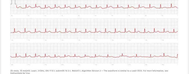 Is anyone able to take a quick look at a heart tracing?❤️
