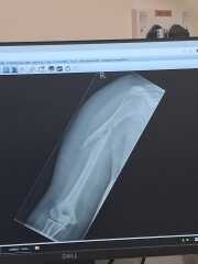 Broken arm and dont trust Dr's after they've consistently messed up.
