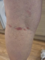 Sores on back of knees, any ideas? Pic attached