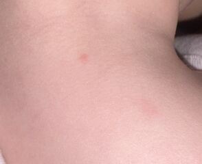 Do you think looks like chickenpox?