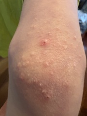 Recurring rash on elbows and knees now bleeding when rubbed