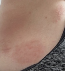 What is this burning rash that’s driving me bananas?