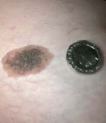 Does this mole look suspicious?