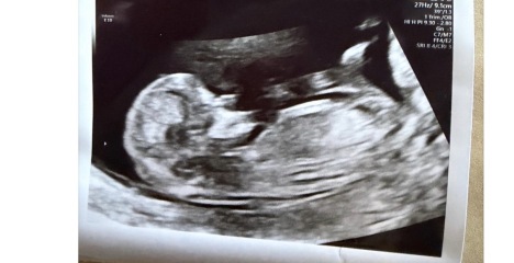 12-week scan, any guesses whether baby is a boy or girl?