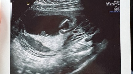 Can you guess the baby's sex from my 15 week scan?