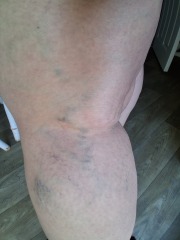 Is this Edema??
