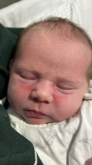 Rash that just won’t disappear, help?!