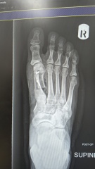 How the hell to cope with bunions?!