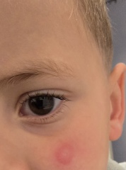 Discoid eczma?
