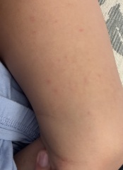 How do you confirm chickenpox?