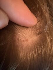 Moles on 11yr old’s scalp! Any dermatologists think this warrants a GP appointment??