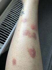 Any doctor or pharmacist - mosquito bites