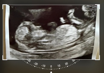 12-week scan, any guesses whether baby is a boy or girl?