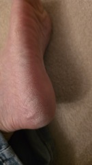 Chronic athlete's foot when antifungal creams worsen neurological side effects
