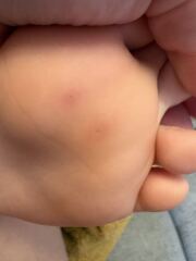 What are these on my son’s foot..